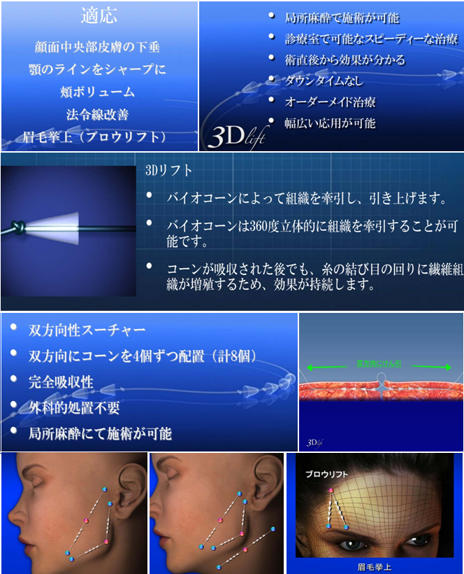 3Dリフト