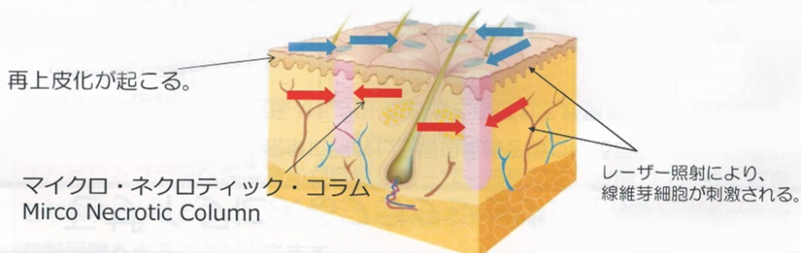 フラクショナルモザイクレーザー