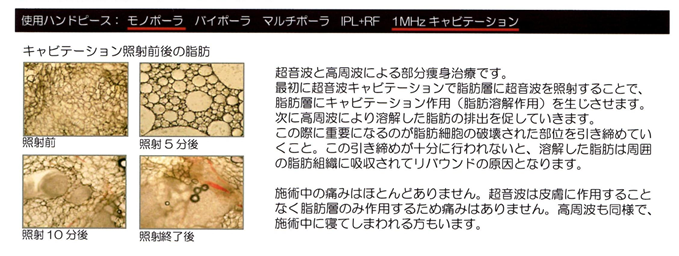 1MHZキャビテーション+RFスリミング(痩身)